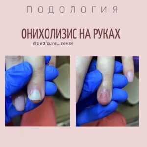 Онихолизис на руках
