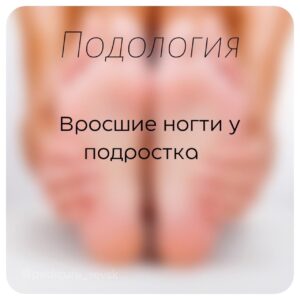 Вросшие ногти у подростков